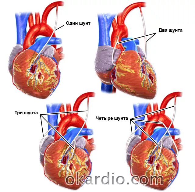 Артерио коронарное шунтирование.  Аорто-коронарное шунтирование (АКШ. Шунтирование клапана сердца. Маммарно коронарное шунтирование сердца. Что такое шунтирование сердца и сосудов