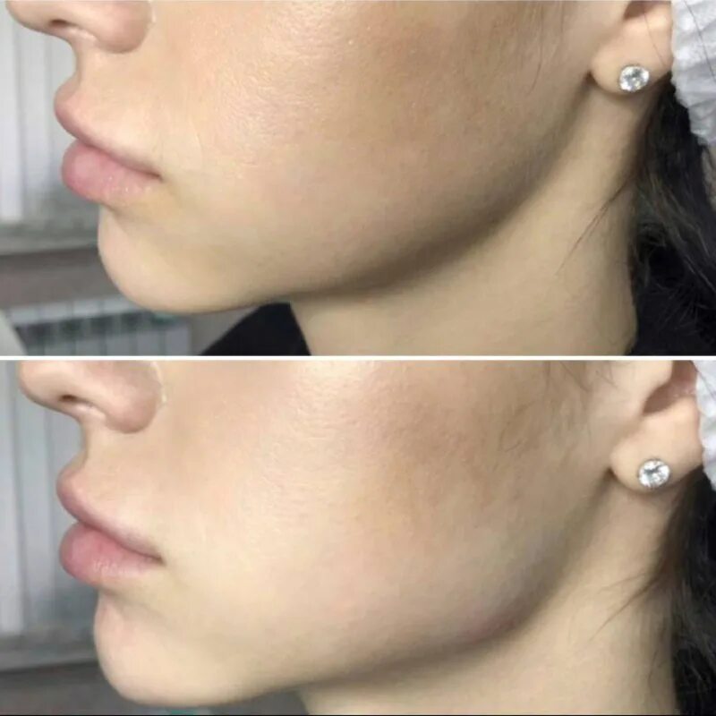 угол скулы. угол молодости анджелины джоли. угол скулы. пластика подбородка. скулы анджелины джоли косметология.