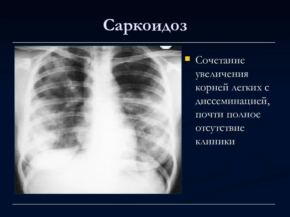 Увеличение корень легкого. Рентгенодиагностика саркоидоза легких. Медиастинально-легочный саркоидоз. Саркоидоз легких рентген. Рентгенограмма при саркоидозе легких.