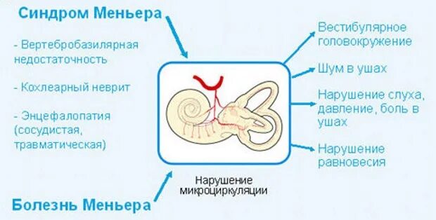 Синдром меньера лечение у женщин. Синдром Меньера клинические рекомендации. Болезни внутреннего уха Меньера. Основные симптомы приступа болезни Меньера.