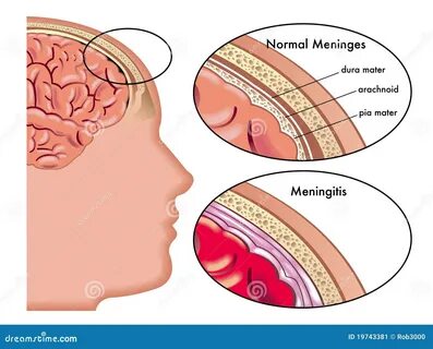 Менингит после болезни
