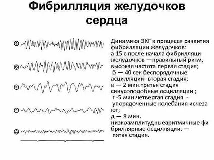 Фибрилляция сердца