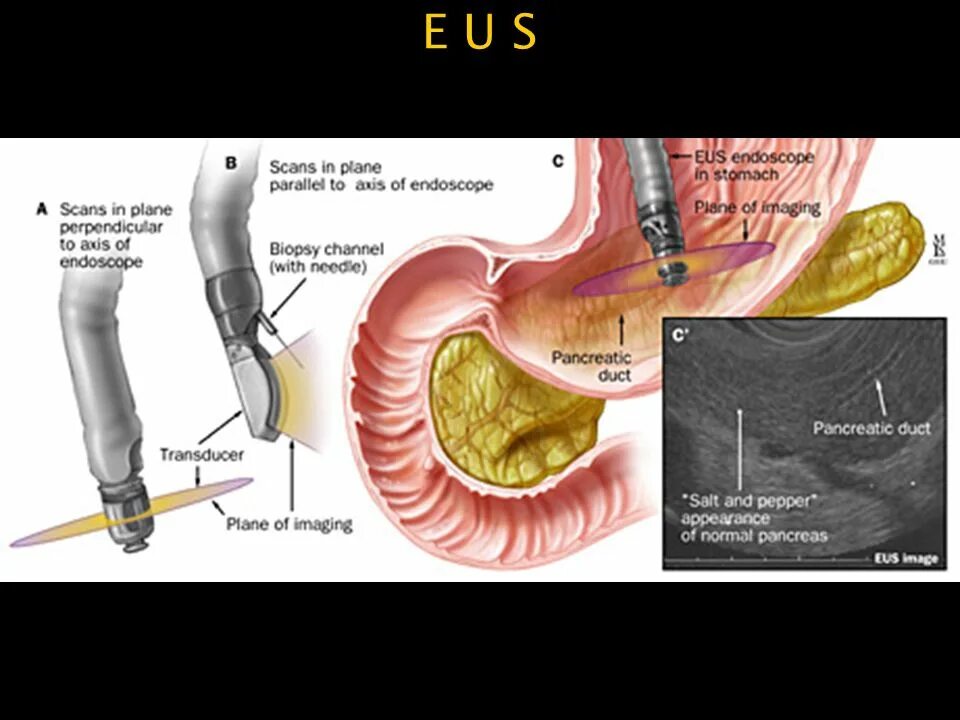 Эндоскопическая ультрасонография поджелудочной железы. Эндоскопическая ультрасонография (ЭНДОУЗИ). Эндоскопическая ультрасонография желчного пузыря. Эус желудка