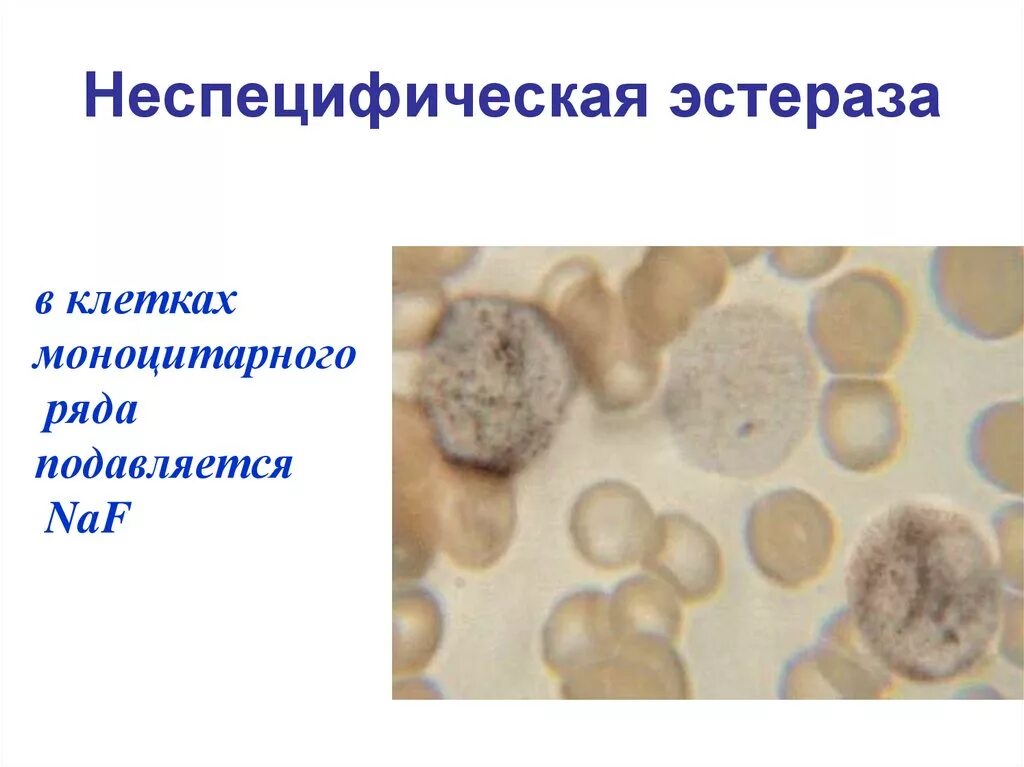 Реакция на лейкоцитарную эстеразу. Неспецифическая эстераза лейкозы. неспецифическая эстераза цитохимия. реакция на неспецифическую эстеразу.