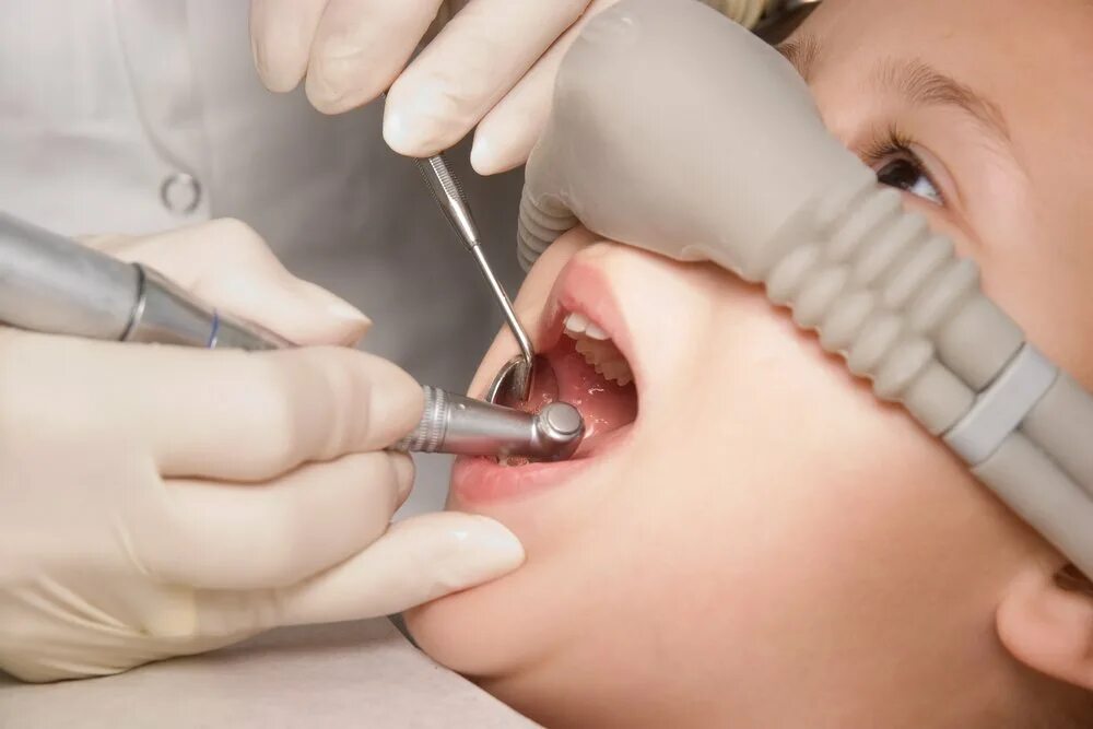 Зубы общий наркоз спб. Закись азота в стоматологии. Седация под закись азота в стоматологии. Закись азота анестезия в стоматологии. Аппарат Matrix седация с севораном.