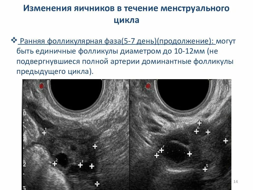 Фолликулы 6 мм. Возрастные изменения яичника. Неовулировавший фолликул. Преждевременной лютеинизацией фолликула.. Доминантный фолликул мрт.