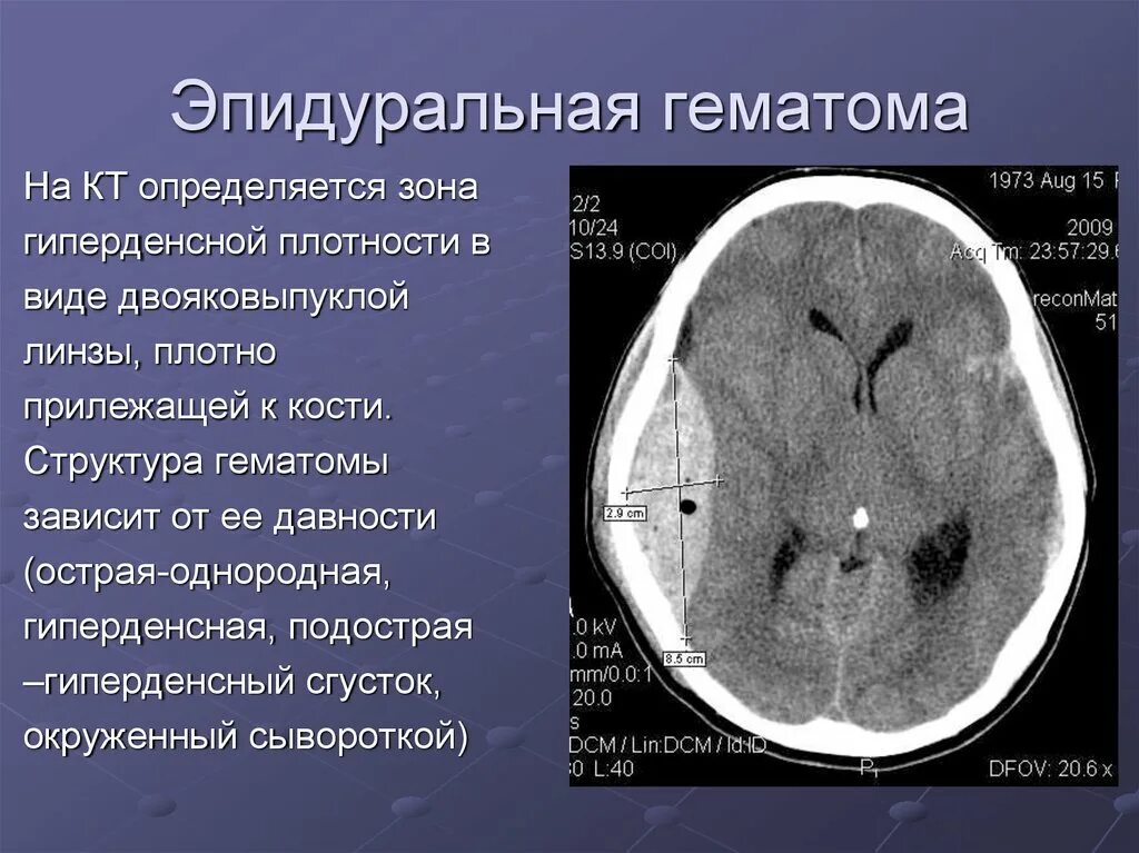 Размягчение головного мозга. Субдуральная и эпидуральная гематома кт. Кт признаки эпидуральной гематомы. Кт эпидуральной и субдуральной гематомы. Хроническая эпидуральная гематома кт.