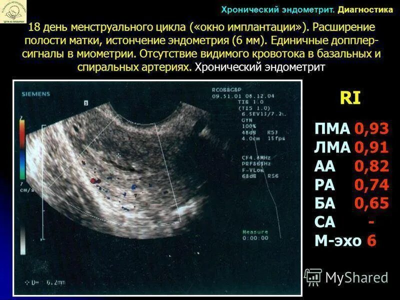 Гинекология эндометрия матки. Эндометрий в полости матки норма на узи. норма эндометрия матки на 6 день цикла. эндометрий на 5 день цикла по узи.