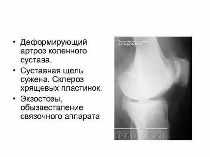 Суставная щель коленного сустава