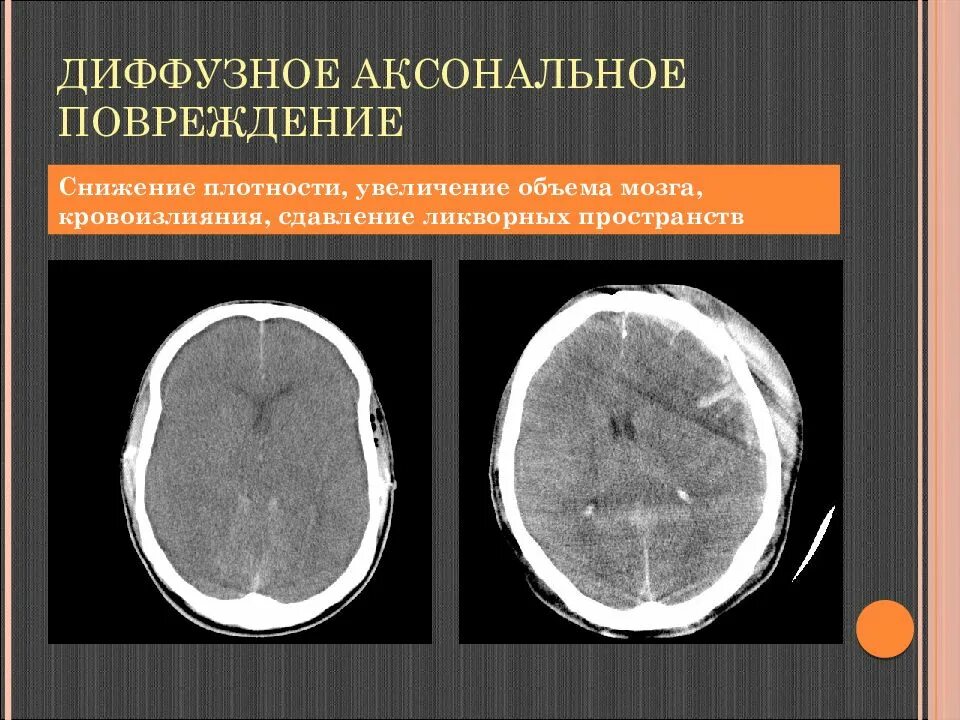 Диффузные нарушения мозга. Аксональное повреждение головного мозга на кт. Диффузное аксональное повреждение кт. Диффузное аксональное повреждение мозга. Диффузное аксональное повреждение мрт.