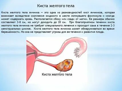 Киста желтого цвета