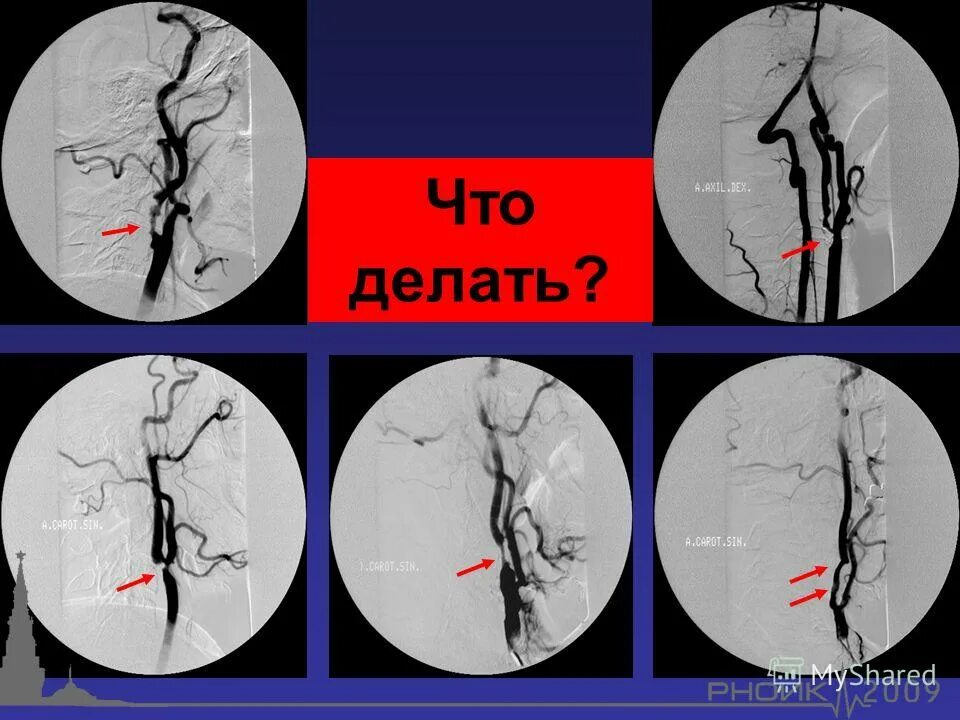 сонная артерия прижимается