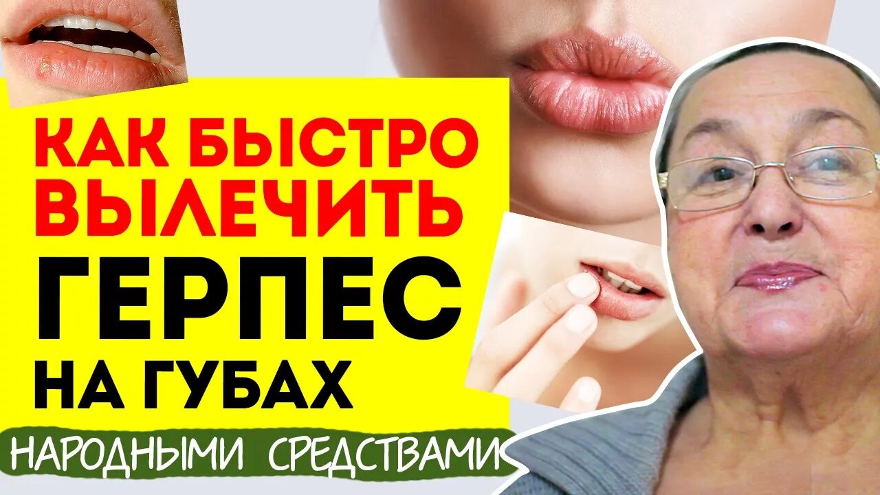 Герпес на губах лечение препараты быстро. Герпес народные средства. Герпес на губах народные средства. Как быстро вылечить герпес на губах народными средствами. Герпес на губах народные методы.