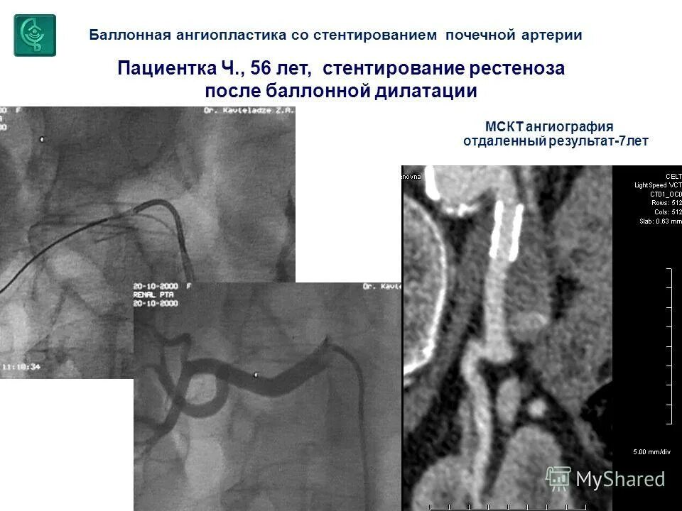 Стентирование почечной артерии. Транслюминальная ангиопластика почечной артерии. Стентирование почечной артерии. Стентирование почечной вены. Стентирование почечной артерии.