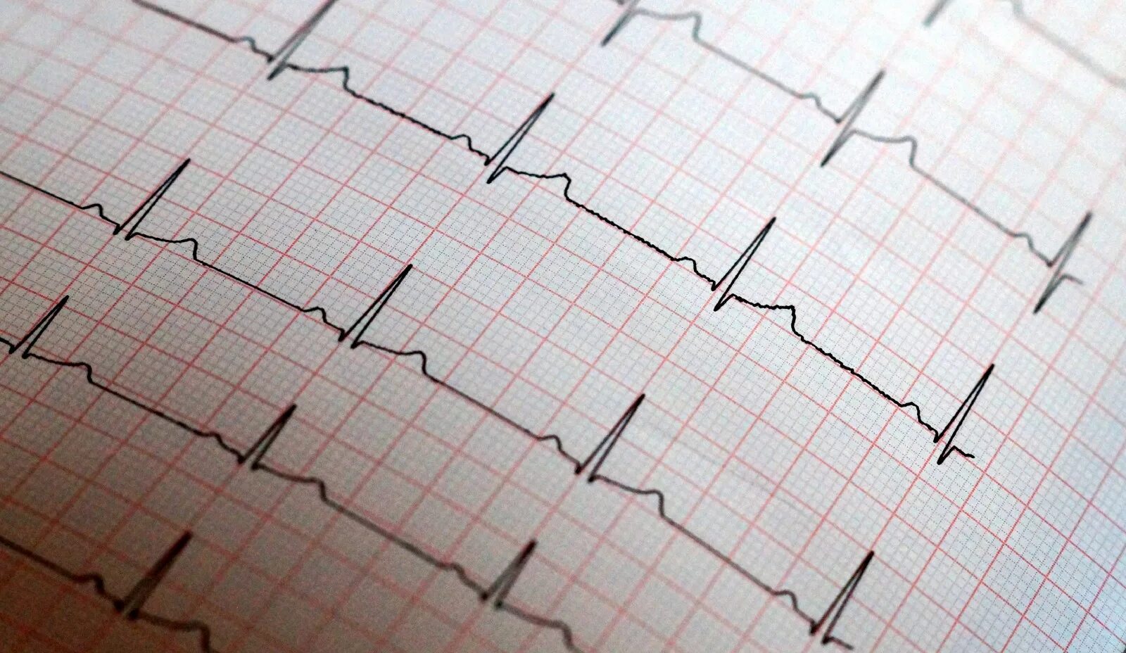 Сбивается сердечный ритм. Ритм сердца на поверхности живота. ecg knowledge. ритм сердца на 27 недели. ritmi11c.