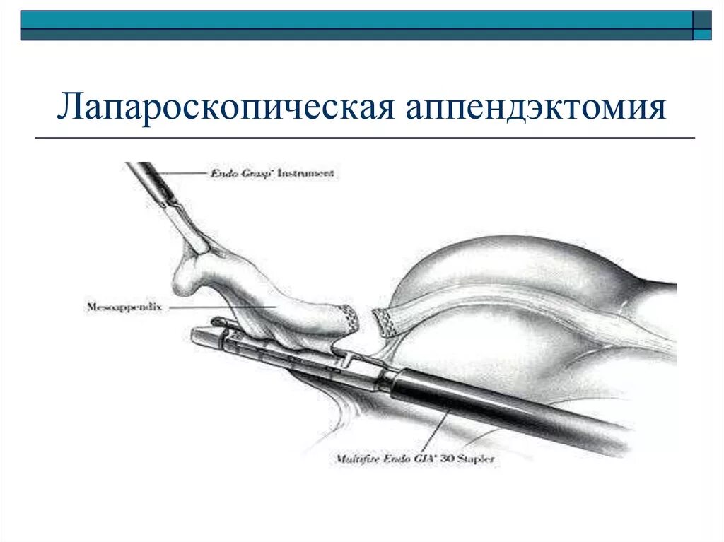 Удаление аппендицита питание. Лапароскопическая аппендицит аппендэктомия. Эндохирургическая аппендэктомия. Доступ лапароскопическая аппендэктомия этапы. Видеолапароскопическая аппендэктомия.