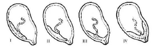 Отслойка с гематомой при беременности. Предлежание плаценты (placenta praevia) — это. Краевое предлежание плаценты. Плацента 3 см. Плацента 3 см.