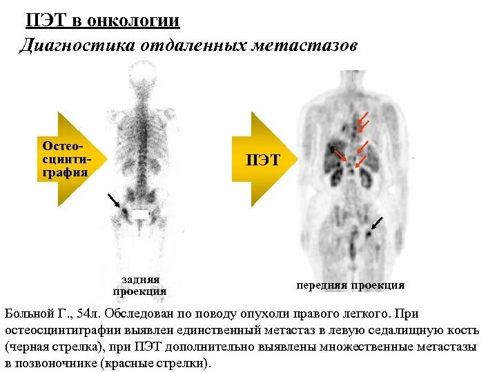 Метастазы в костях при раке легких. Остеосцинтиграфия метастазы. диагностика отдаленных метастазов. проекция исследования остеосцинтиграфия. остеосцинтиграфия заключение метастазы.