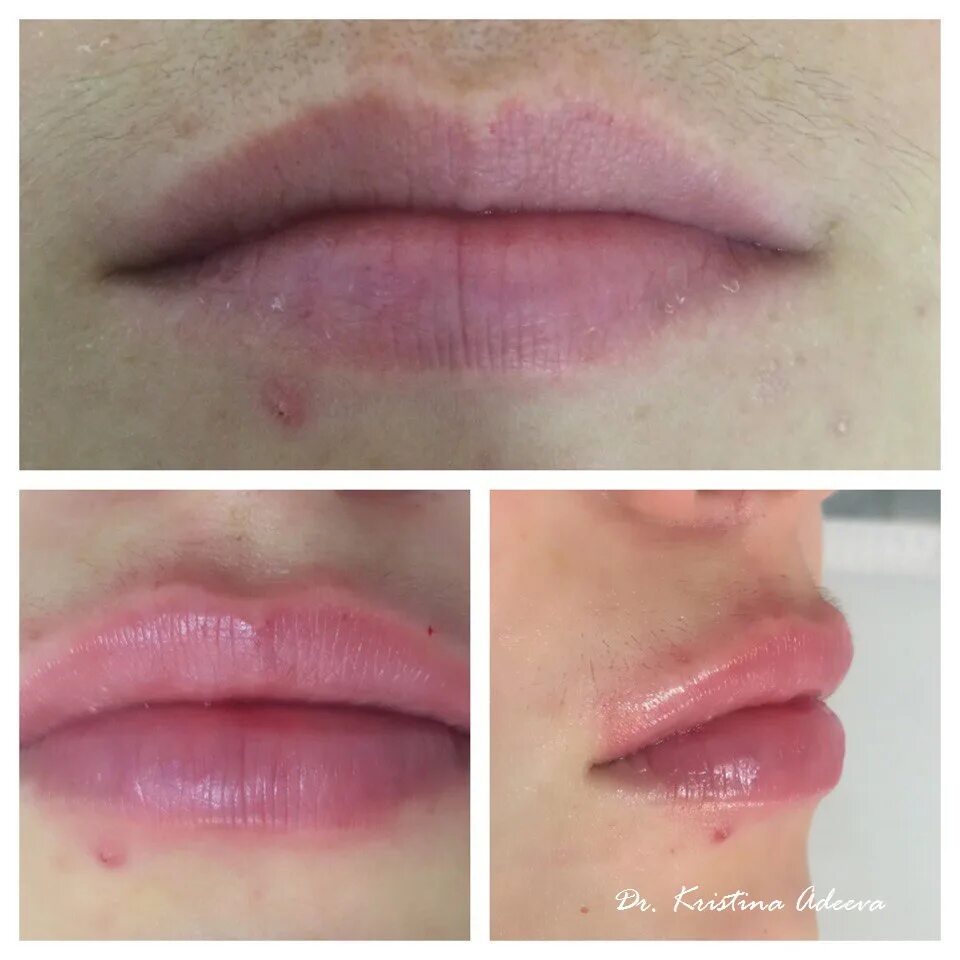 Губы после ювидерм. Juvederm ultra 3 1 ml что это. ювидерм ультра 3 1 мл до и после увеличения губ. препарат ювидерм для увеличения губ.
