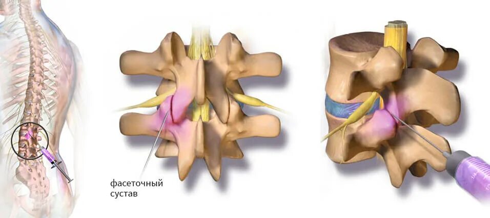 Фасеточная блокада. Фасеточные суставы поясничного отдела позвоночника. Блокада фасеточного сустава l5-s1. Спондилоартроз фасеточный синдром. Артроз фасеточных суставов l1-s1.