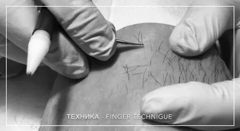 Электроэпиляция нитью