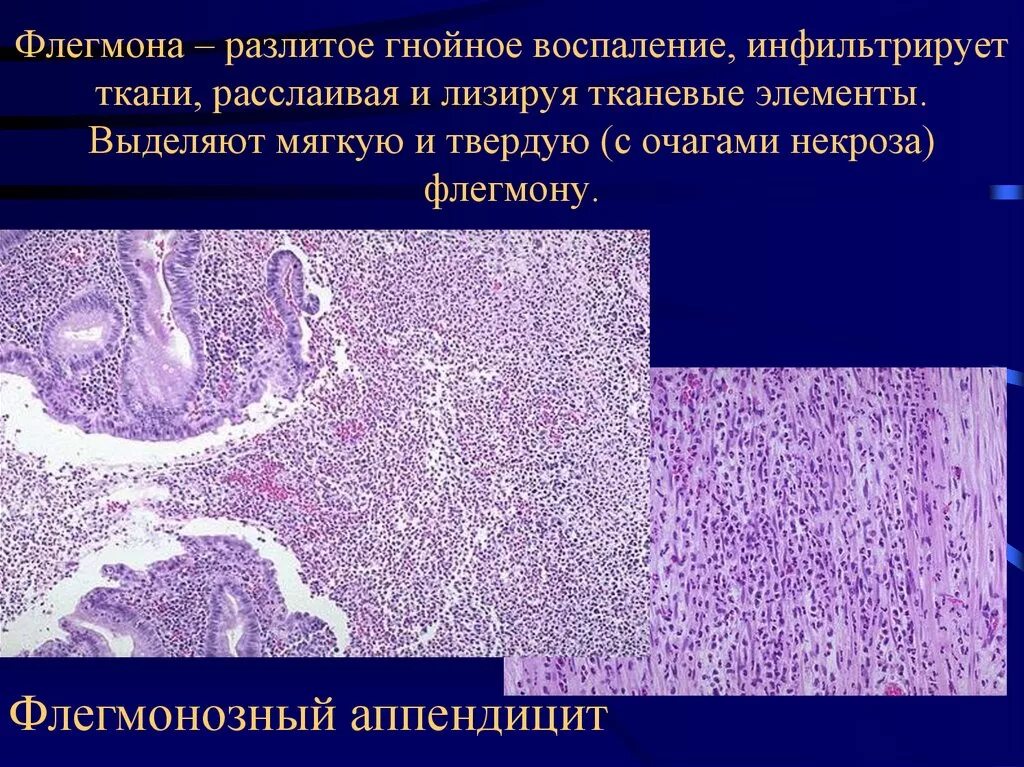 Флегмонозный аппендицит патологическая анатомия. Флегмона кожи патанатомия. Флегмона подкожной клетчатки патанатомия. Флегмонамягуких тканей препарат. Гнойный характеристика