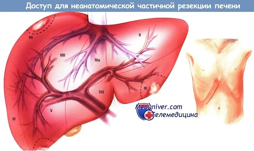 Операция резекция печени. Клиновидная резекция печени. Атипичные резекции печени. Типичная и атипичная резекция печени. Неанатомические резекции печени.