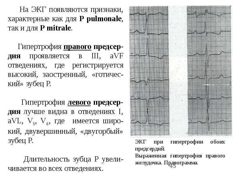 Гипертрофия п п ЭКГ. Гипертрофия правого желудочка на ЭКГ. Зубец р-pulmonale на ЭКГ. P pulmonale на ЭКГ критерии. Гипертрофия левого предсердия левого желудочка