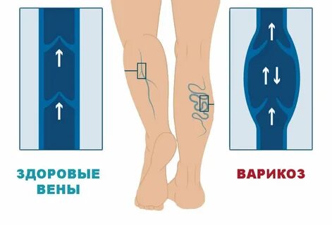 Недостаточность венозного клапана
