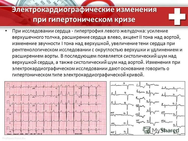 Стадия и механизмы развития гипертрофии миокарда. Экг признаки артериальной гипертензии. Гипертрофия 1 2 степени. Гипертрофия 1 2 степени. Гипертрофия левого желудочка диагноз.