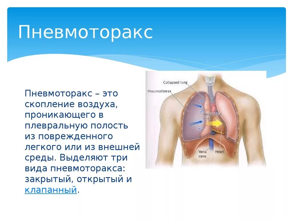 Симптомы при пневмотораксе.