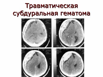 Черепно мозговая травма гематома