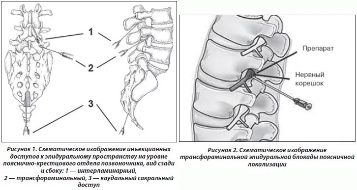 Паравертебральная поясничная блокада. Трансфораминальная блокада поясничного отдела. Блокада пояснично-крестцового отдела схема. Паравертебральная блокада методика. Блокада корешка l5-s1 техника.