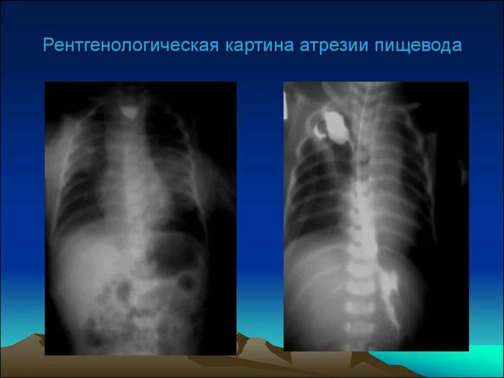 Атрезия пищевода. Адгезия пищевода рентген. атрезия пищевода рентген. артерия пищевода рентген. атрезия пищевода у детей рентген.