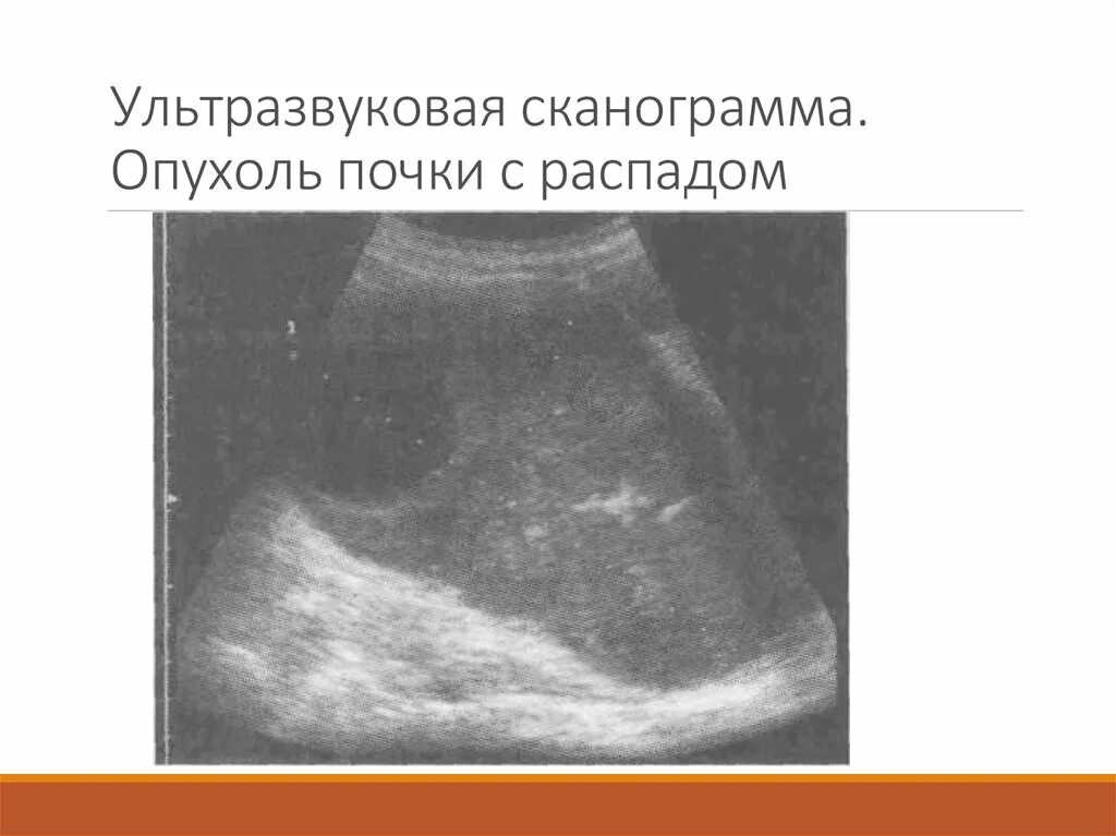 Сканограмма почек. Распад почки