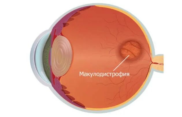 Тест сетчатки глаза. Макулодистрофия, макулярная дегенерация. Макула дистрофия сетчатки глаза. Возрастная макулодистрофия глазное дно. Макулярная дегенерация сетчатки глаза.