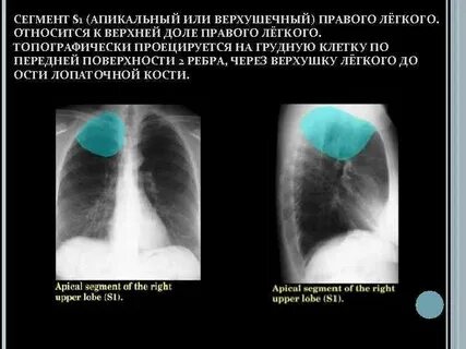 Фиброзные изменения верхних долей легких