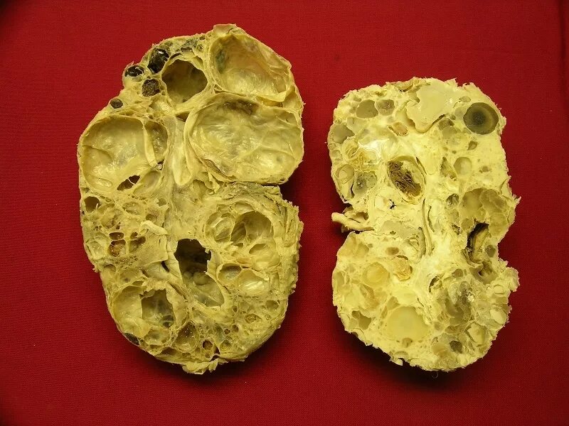 поликистоз почек симптомы лечение