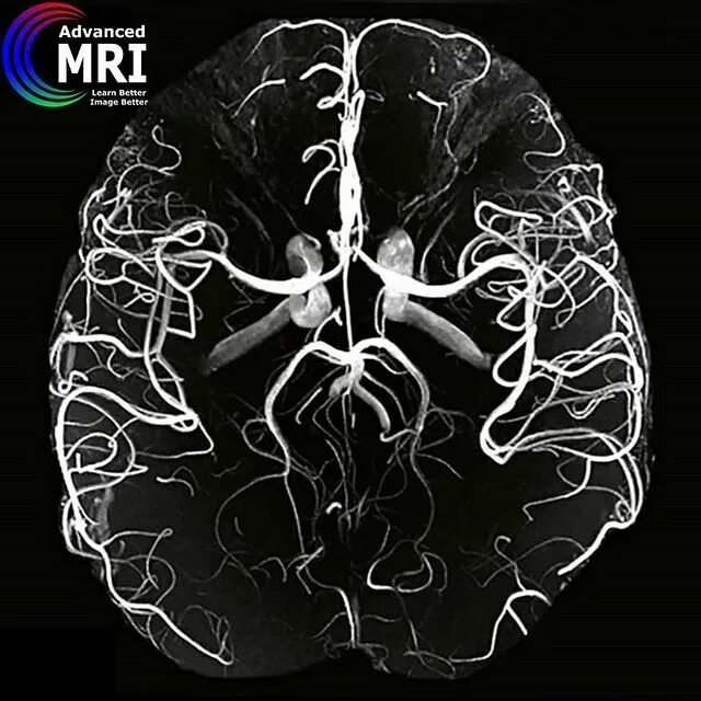 мрт ангиограмма сосудов головного мозга. кт ангиография гм. мрт венография сосудов головного мозга. мрт сосудов головного мозга с контрастом. мрт венография сосудов головного мозга.