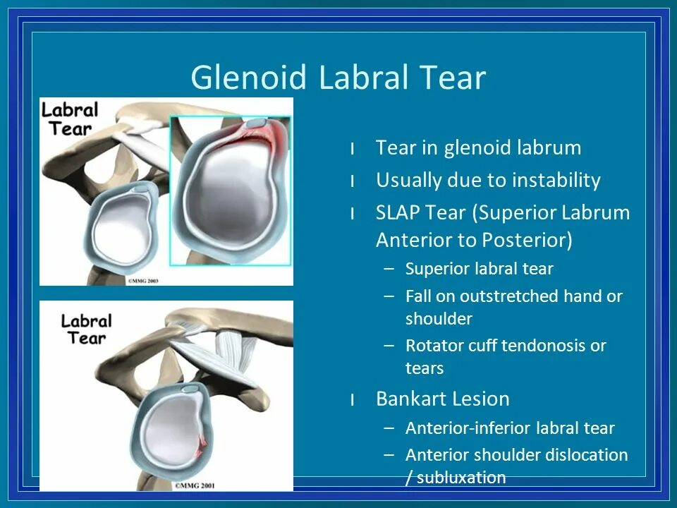 Tear me перевод. Glenoid Labrum. Ретрактор тканей anterior glenoid. Банкарта плечевого сустава.