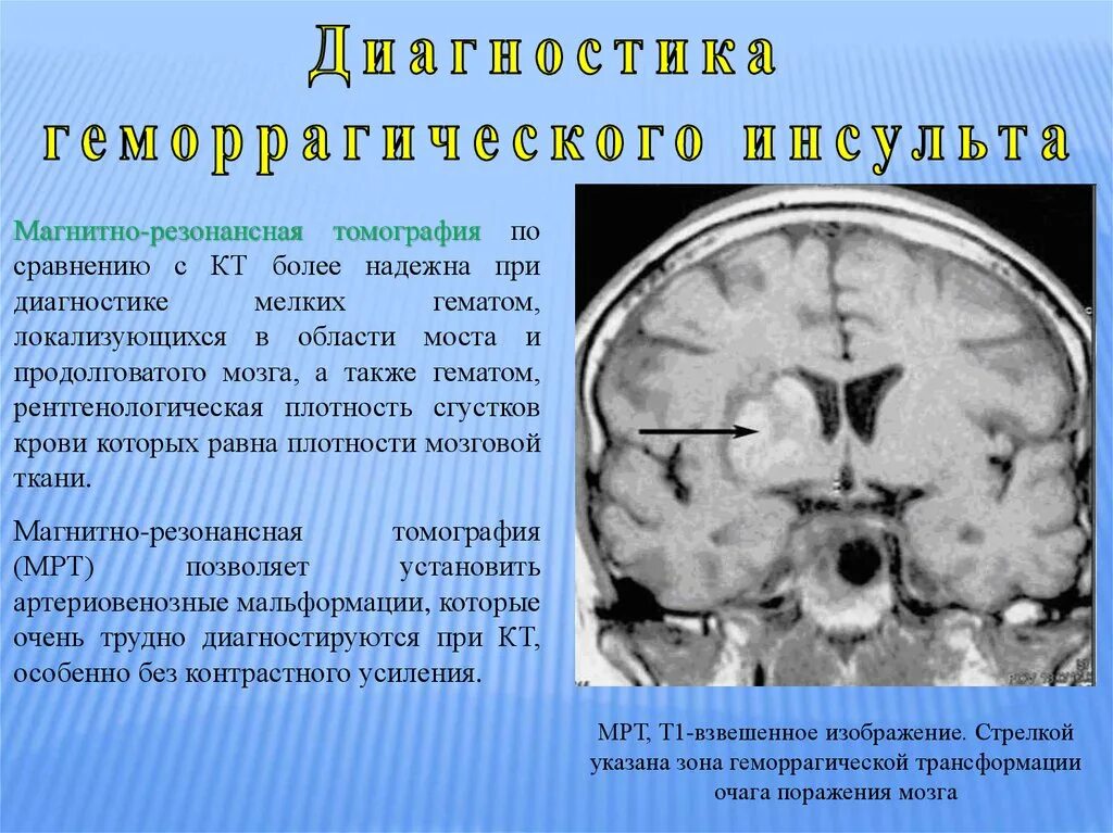 Геморрагический вентрикулярный инсульт клиника. Геморрагический инсульт патанатомический диагноз. Геморрагический инсульт головного мозга кт. Кт ангиография геморрагический инсульт. Был геморрагический инсульт