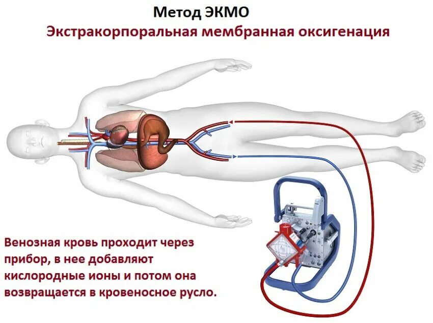 Что такое экмо в медицине