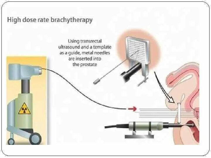 Брахитерапия предстательной железы. Аппликаторы для брахитерапии шейки матки. Контактная лучевая терапия брахитерапия это. Внутриполостной брахитерапии. Брахитерапия простаты цена