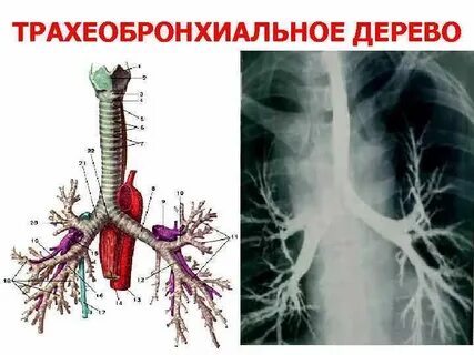 Рак трахеи