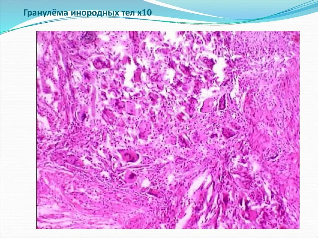 Клетка типа инородных тел. Гигантоклеточная репаративная гранулема гистология. гранулема инородного тела гистология. гигантоклеточная гранулема инородных тел. гранулема инородного тела микропрепарат.