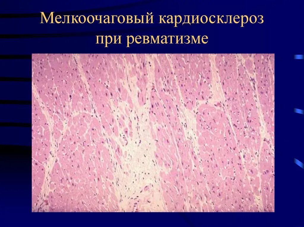 Диффузное соединительных тканей