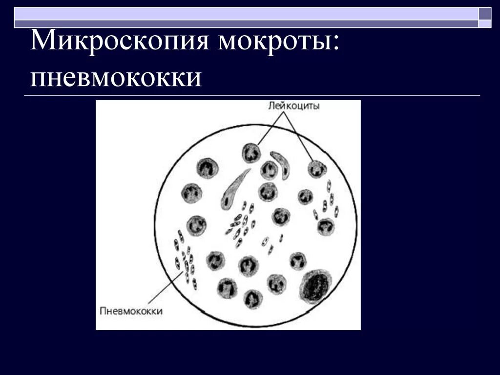 Элементы мокроты. Эластические волокна в мокроте микроскопия. Клеточные элементы мокроты микроскопия. Микроскопические элементы мокроты. Исследование мокроты микроскопия.