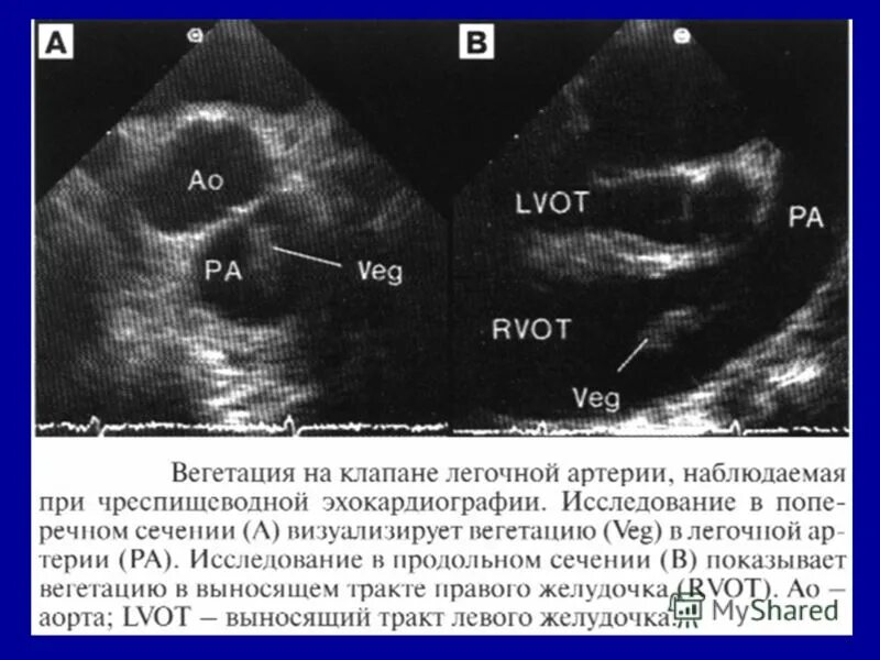 Выпотной перикардит ЭХОКГ. Инфекционный эндокардит Эхо. Вегетации на аортальном клапане ЭХОКГ. Вегетация сердца