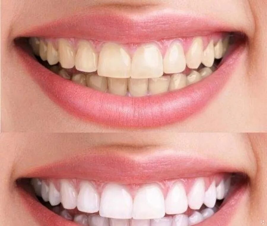 Отбеливание зубов самара. Отбеливание зубов до и после. Косметическое отбеливание зубов. Косметологическое отбеливание зубов. Косметическое отбеливание зубов реклама.