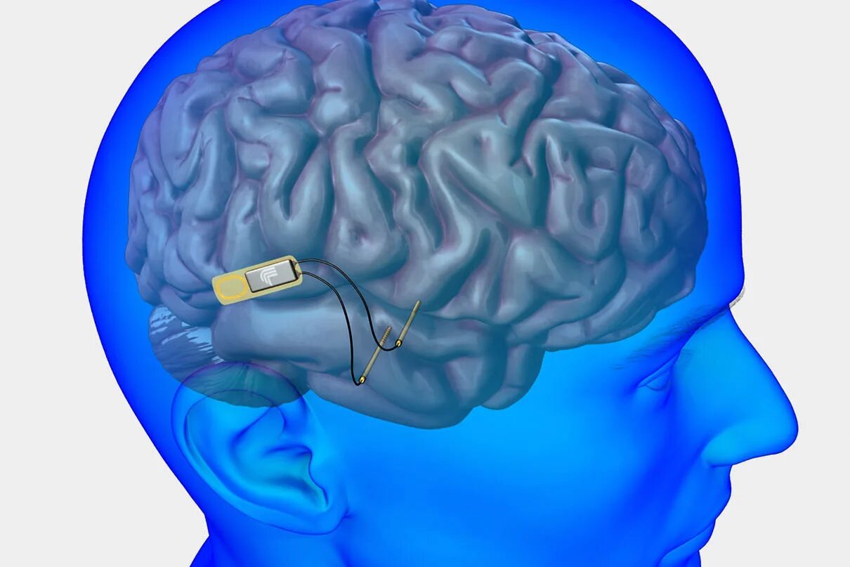 Восстановление деятельности головного мозга. Чип в мозг.